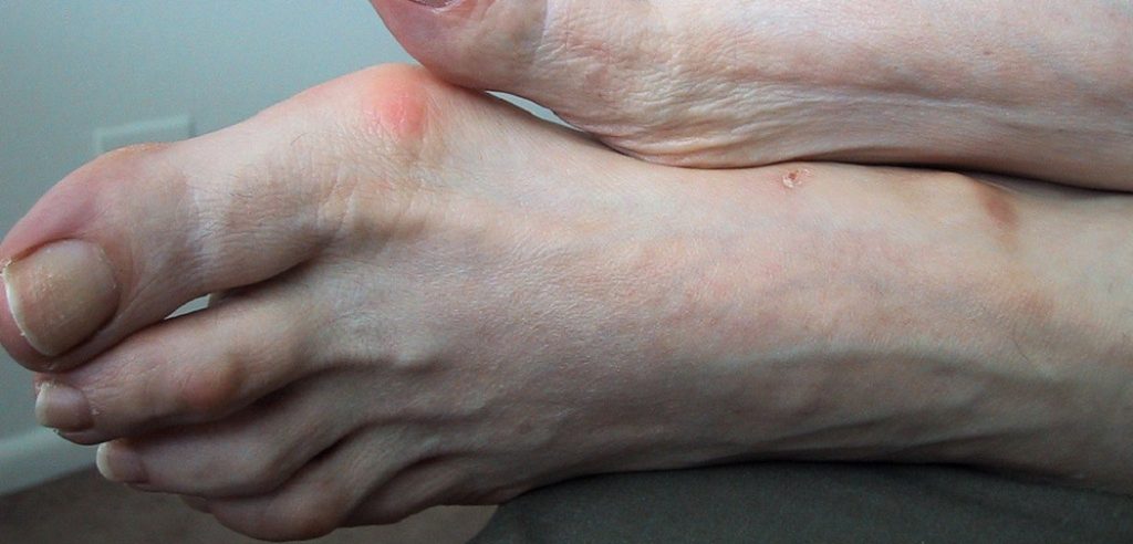How to Fix Ugly Toes