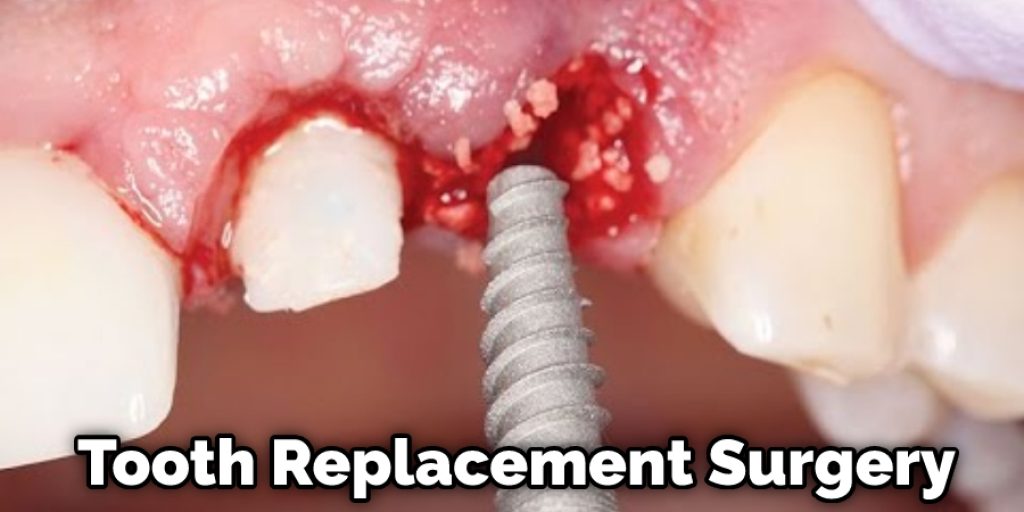 Tooth Replacement Surgery