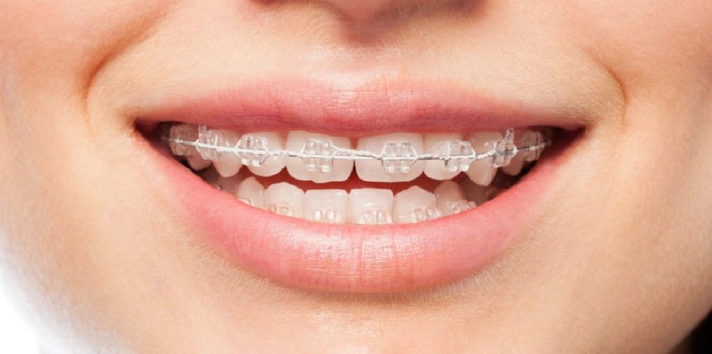 How Does Teeth Aligners Work