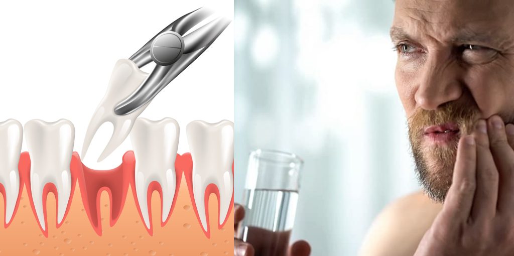 How to Drink Water After Tooth Extraction