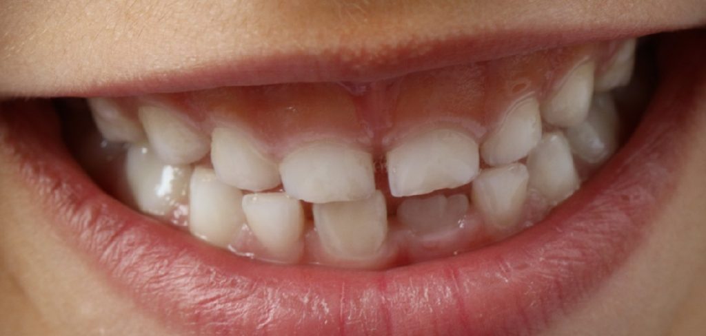 How to Fix a Gap in Your Teeth at Home