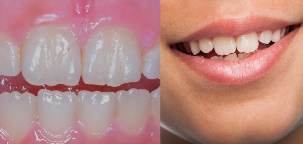 How to Get Rid of Ridges on Teeth
