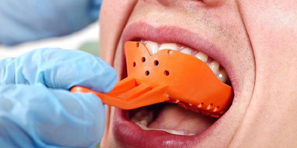 How to Make Teeth Impressions at Home