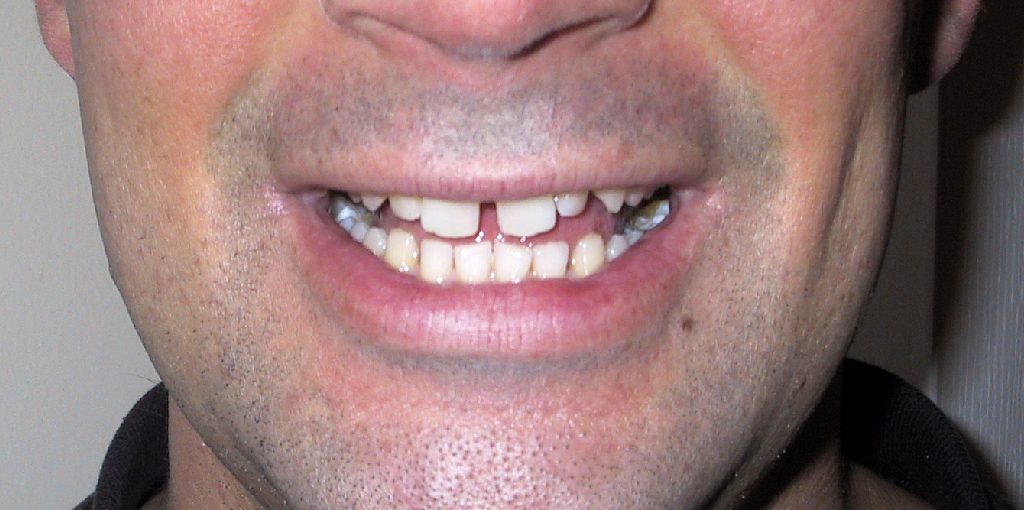 How to Make a Gap in Your Teeth at Home