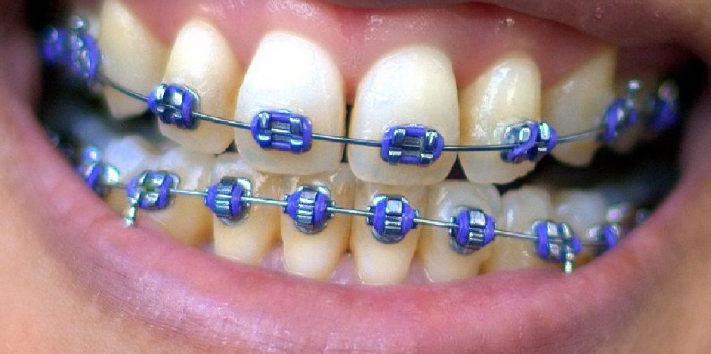 How to Remove Braces at Home Safely