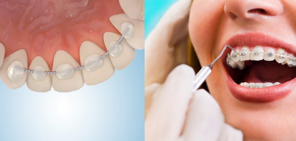 How to Remove Permanent Retainer at Home