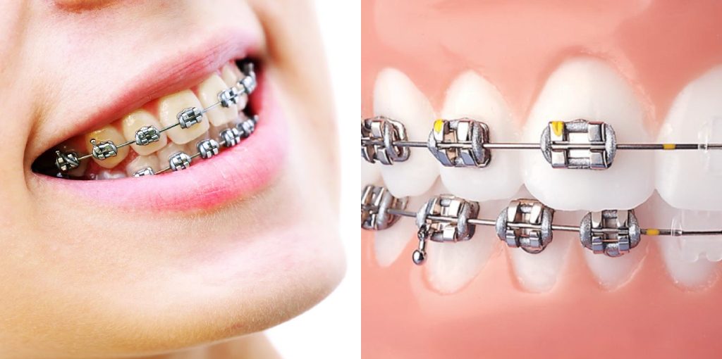 How to Remove Yellow Stains From Braces Bands