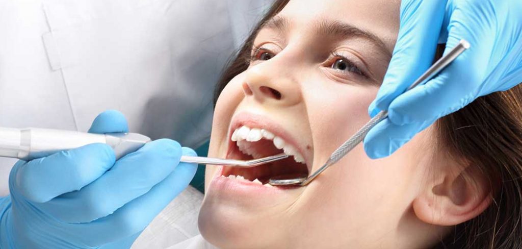 How to Whiten Fillings on Teeth