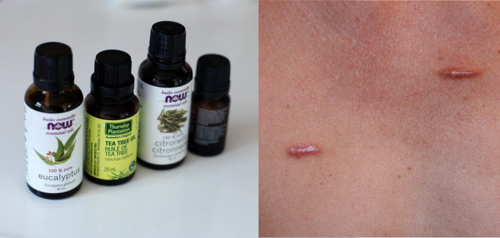 How to Use Tea Tree Oil for Keloids