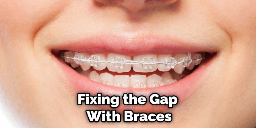 Fixing the Gap With Braces