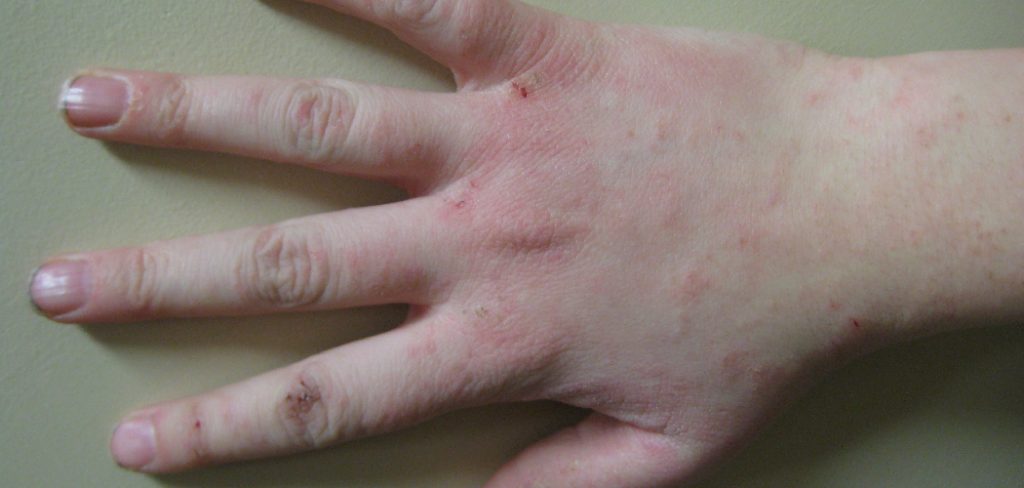how to get rid of epoxy rash