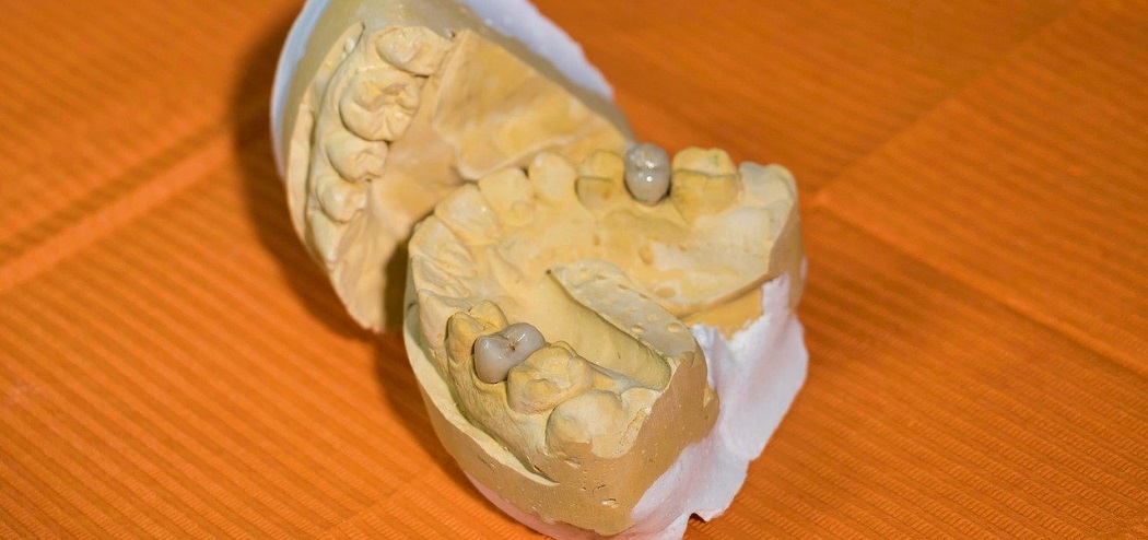 How to Make a Homemade Mold of Your Teeth