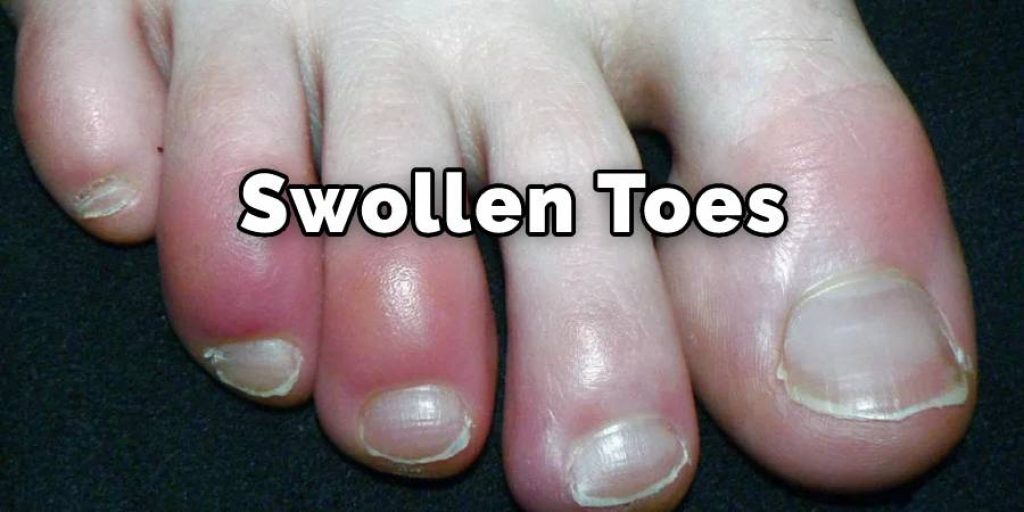 Swollen toes