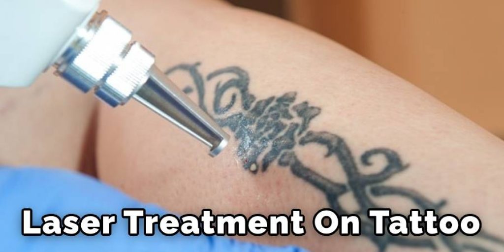 Laser Treatments on Tattoo