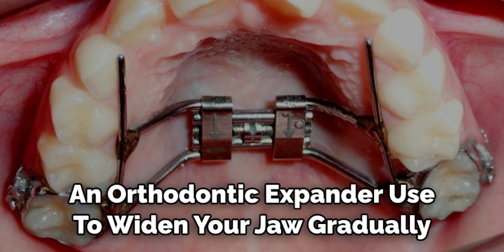 An Orthodontic Expander Use To Widen Your Jaw Gradually
