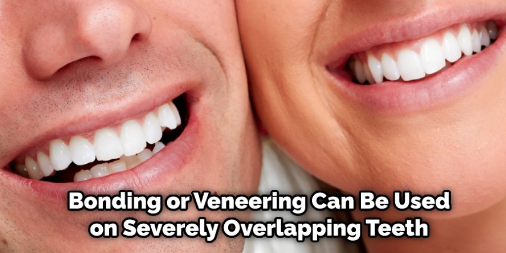 Bonding or Veneering Can Be Used on Severely Overlapping Teeth
