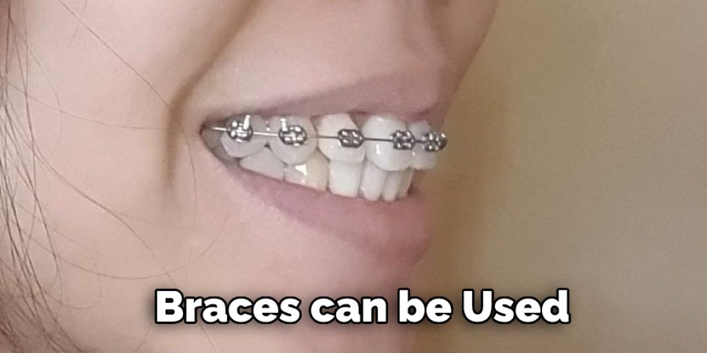 Braces can be used