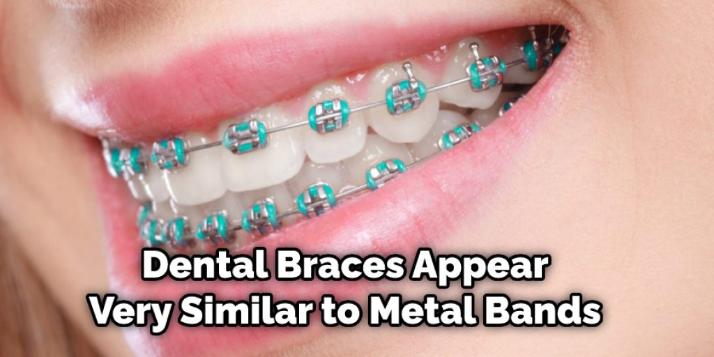 Dental Braces Appear Very Similar to Metal Bands