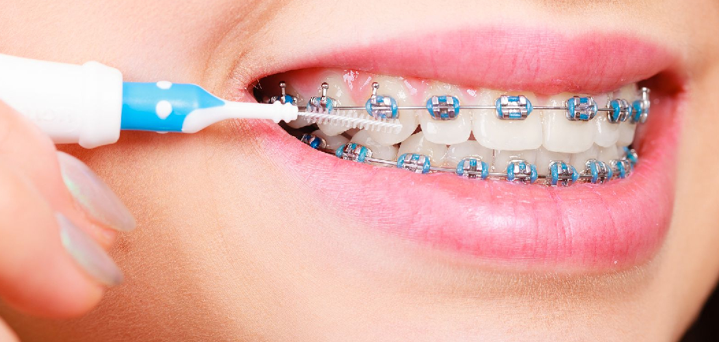 How to Avoid White Spots on Teeth With Braces