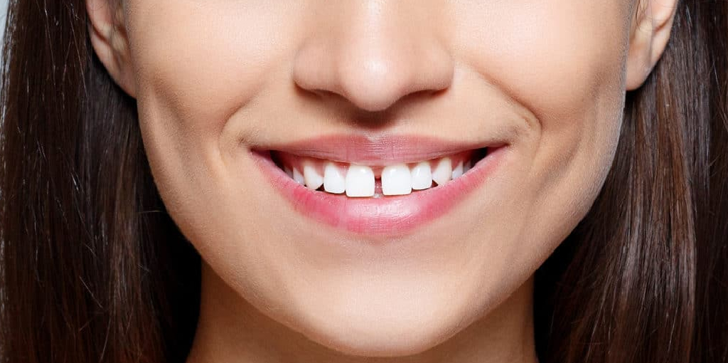 How to Close a Gap in Your Teeth Without Braces