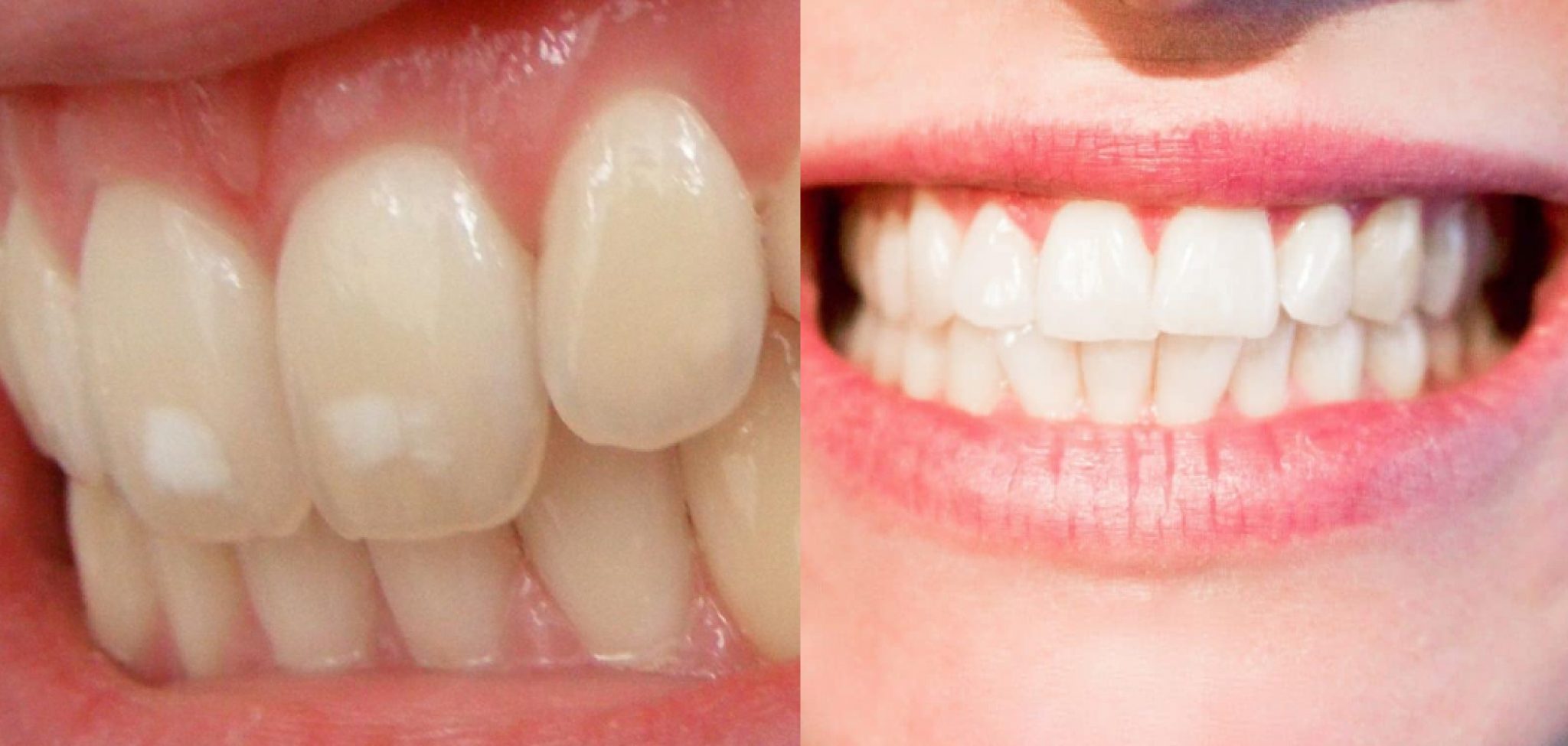How To Fix Decalcification After Braces 8 Magnificent Ways 2023