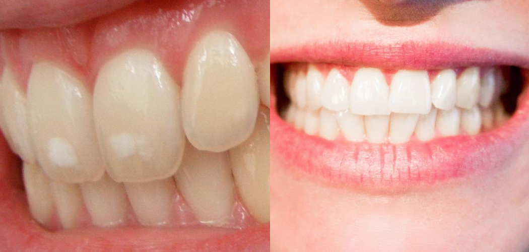 How to Fix Decalcification After Braces
