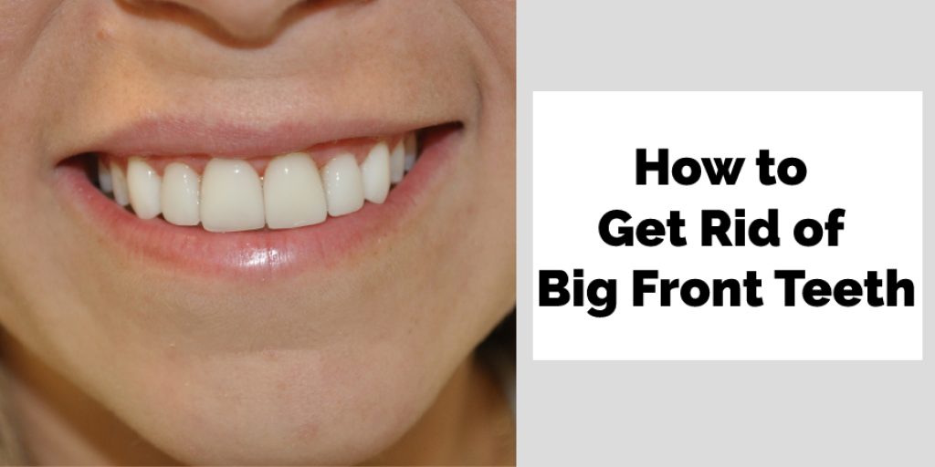 How to Get Rid of Big Front Teeth