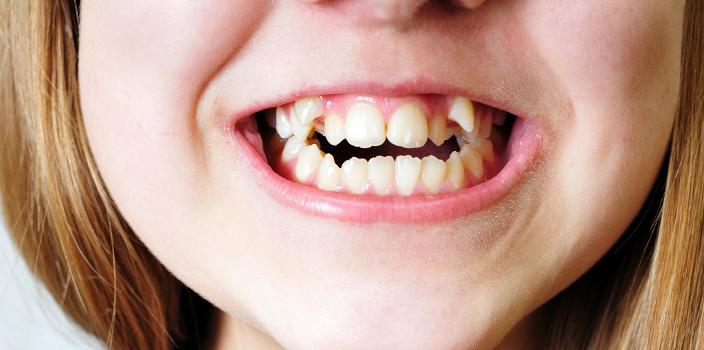How to Get Rid of Vampire Teeth