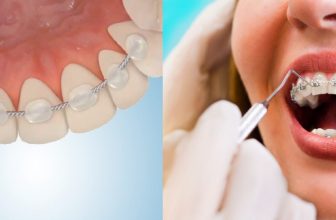How to Remove Permanent Retainer at Home
