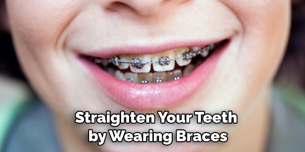 Straighten Your Teeth by Wearing Braces