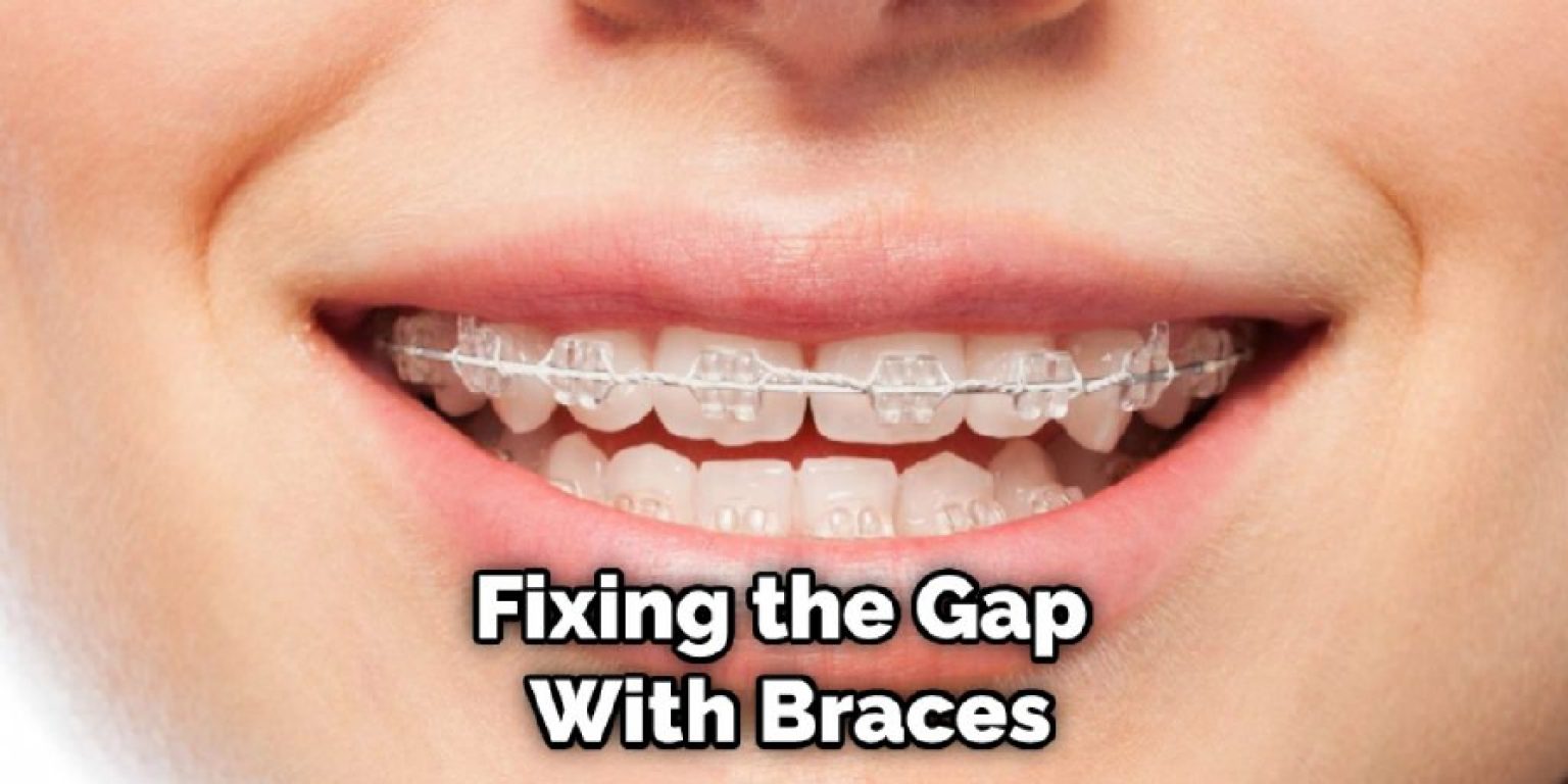 How To Fix Small Gap In Front Teeth 10 Simple Ways 2024