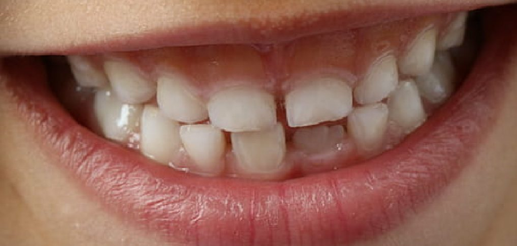 How to Fix Small Gap in Front Teeth